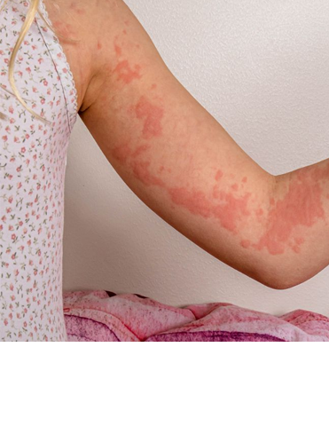 Histamine